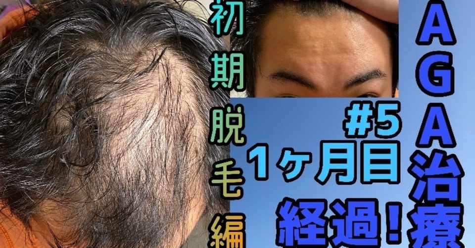 Aga治療1ヶ月経過 効果や変化を振り返ります コウch Note