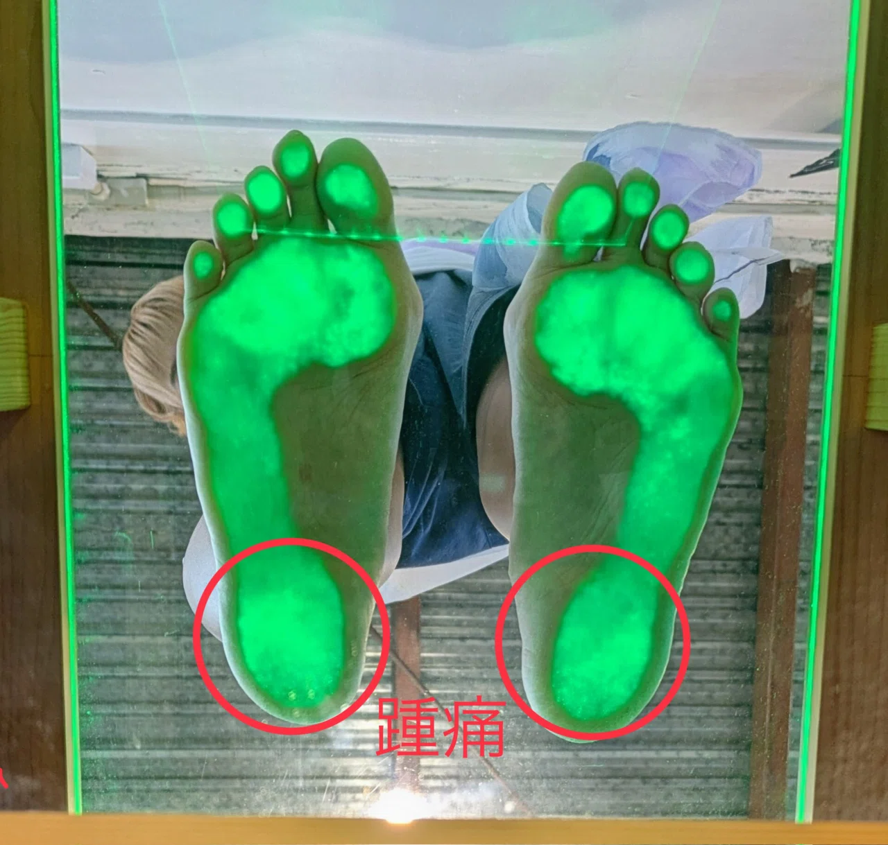 踵痛とクッション｜FitInsole