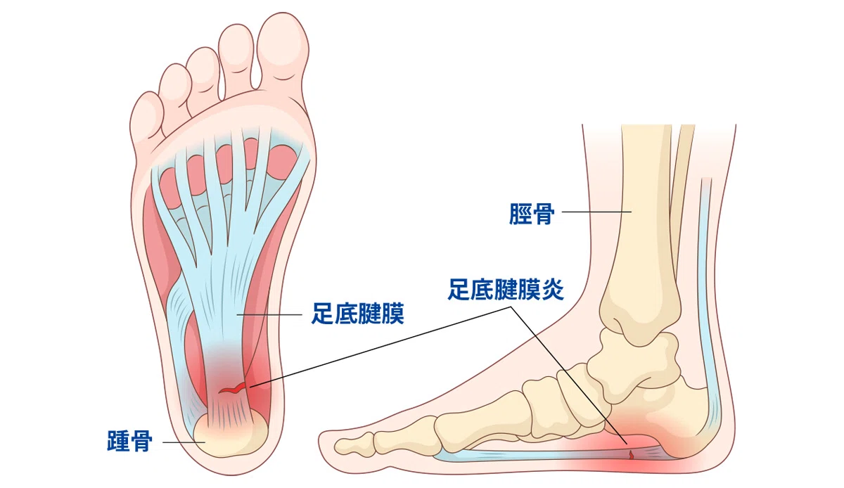 踵痛とクッション｜FitInsole