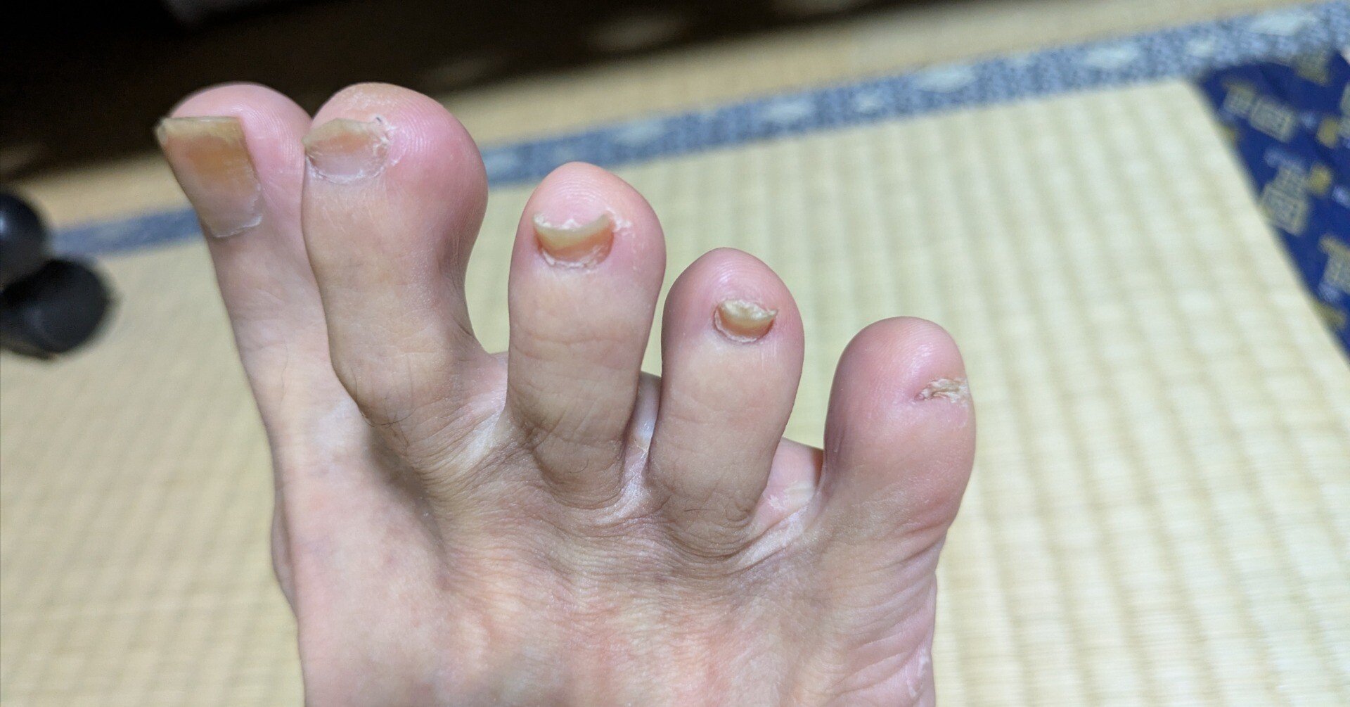 左足の小指の爪 Amazon | サイプラス 小指爪を摩擦から守るサポーター 曲がった小指