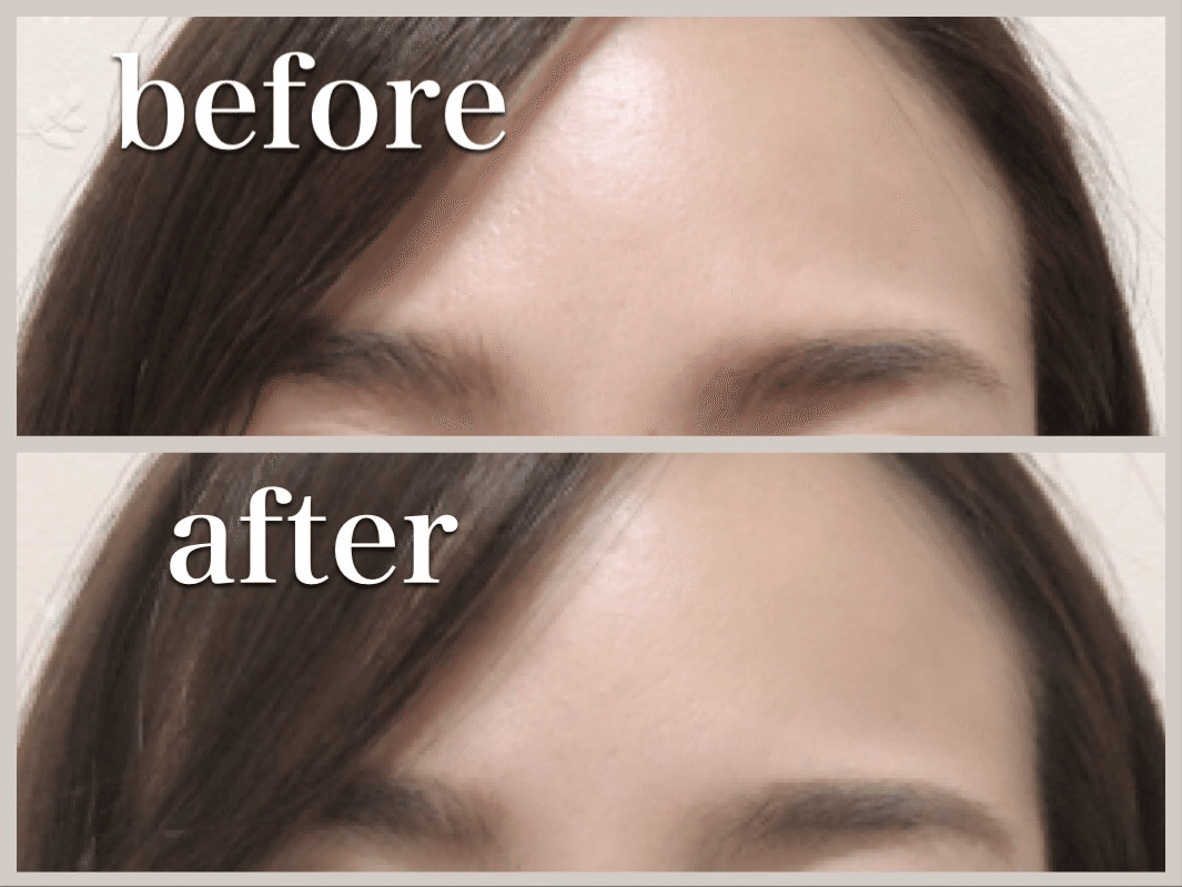 顔のシワが消える！？美容医療「ボトックス」レビュー｜花ユイ【 コスメコンシェルジュ】, image size:1065x799