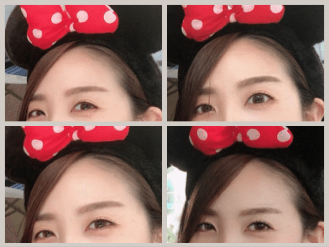 顔のシワが消える！？美容医療「ボトックス」レビュー｜花ユイ【 コスメコンシェルジュ】, image size:1065x799