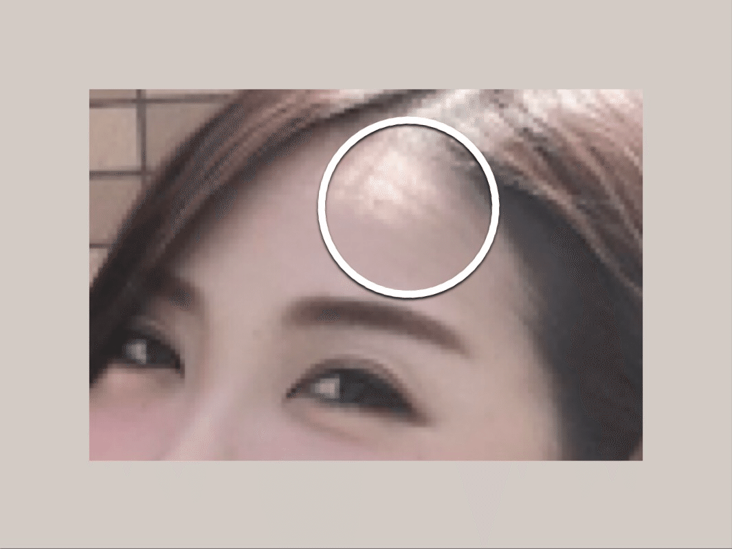 目尻・目の下ボトックス注射｜ボツリヌストキシン注射（1部位）｜目尻のシワ｜1カ月保証 | 横浜TAクリニック, image size:1065x799