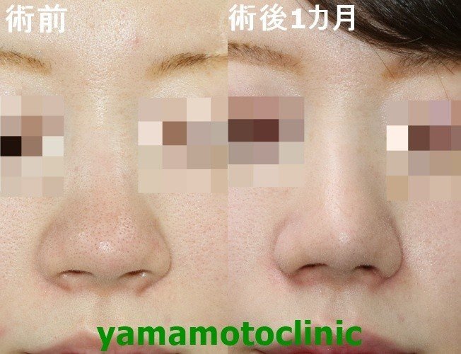 鼻の存在感を小さくする整形 新宿 山本クリニック Note 鼻の存在感を小さくする整形 新宿 山本クリニック Note
