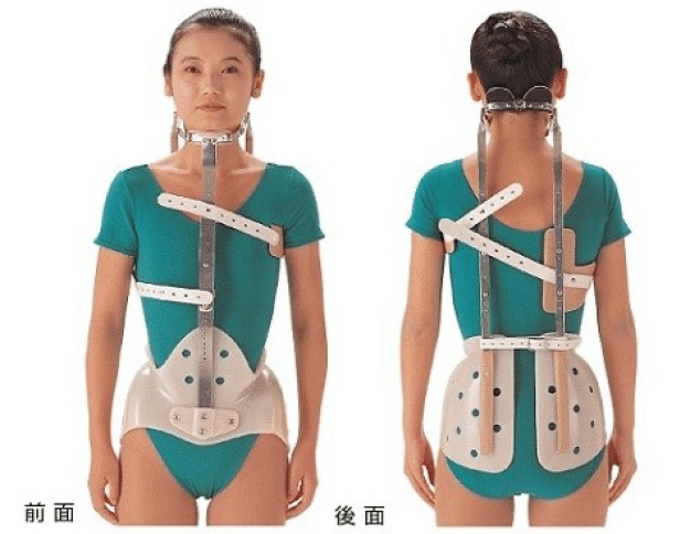 側弯症｜コルセットをつけることになった日｜あの時の絶望と今