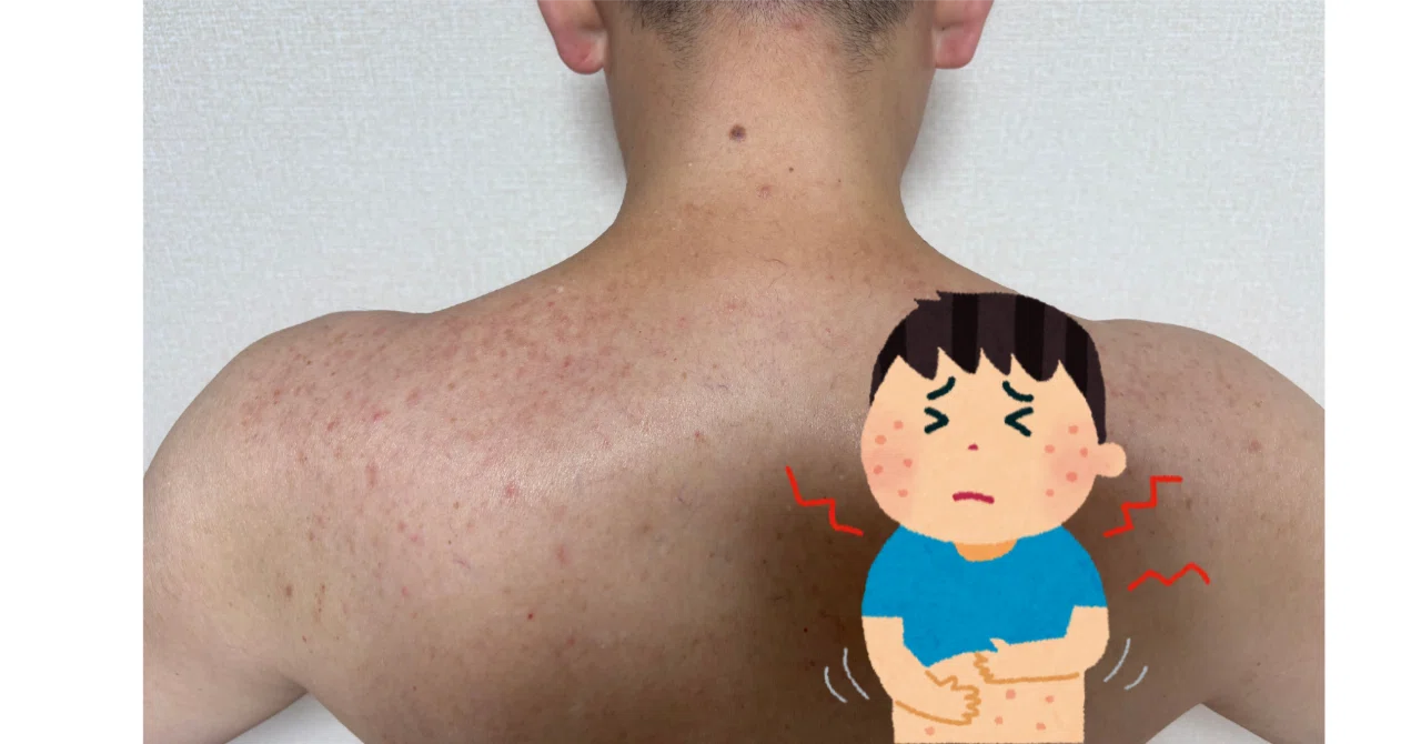 You'll regret not knowing this! Is your winter hand eczema actually ...