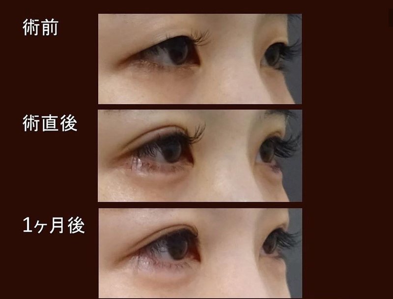 Tcb東京中央美容外科がやばい 二重整形を体験してきて感じた感想 口コミを本音レポート 美容クリニック評論家 Note Tcb東京中央美容外科がやばい 二重整形を体験してきて感じた感想 口コミを本音レポート 美容クリニック評論家 Note