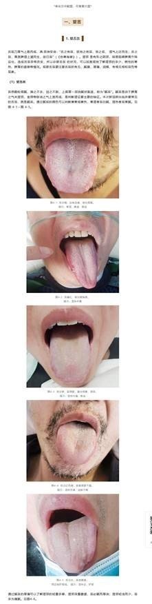 舌 が ピリピリ コロナ