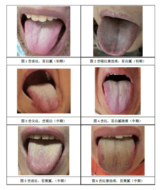 新型コロナウイルス感染症の舌診について 医道の日本社 Note