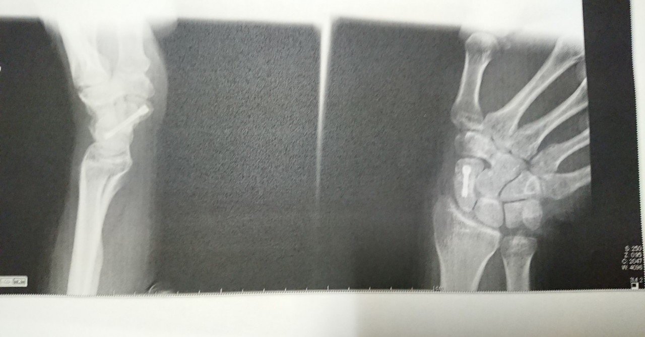 骨折の治療記録 Takayuki Ogata Note