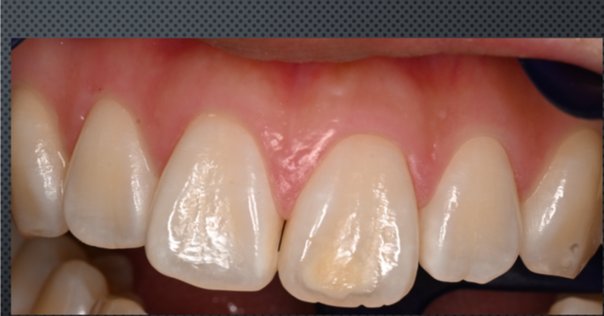 テーラーメード型MI審美歯科治療 書籍詳細「テーラーメイド型 MI審美