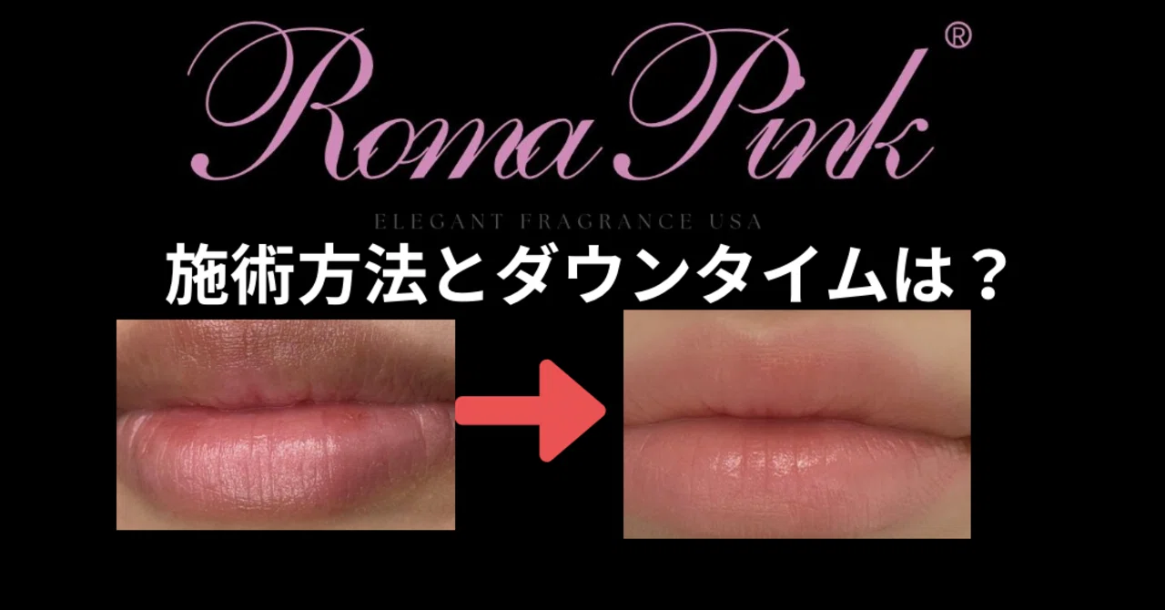話題のローマピンク、施術方法は？ダウンタイムは？ （Dearskin