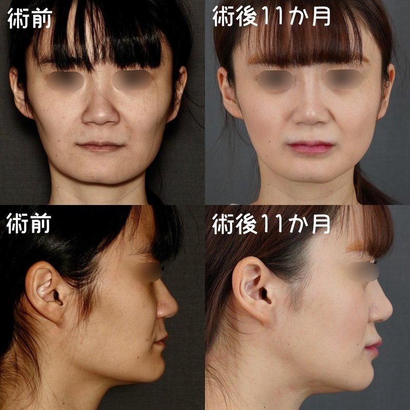 角張ったフェイスラインからの小顔の作り方 骨切りドクター宮崎 Note