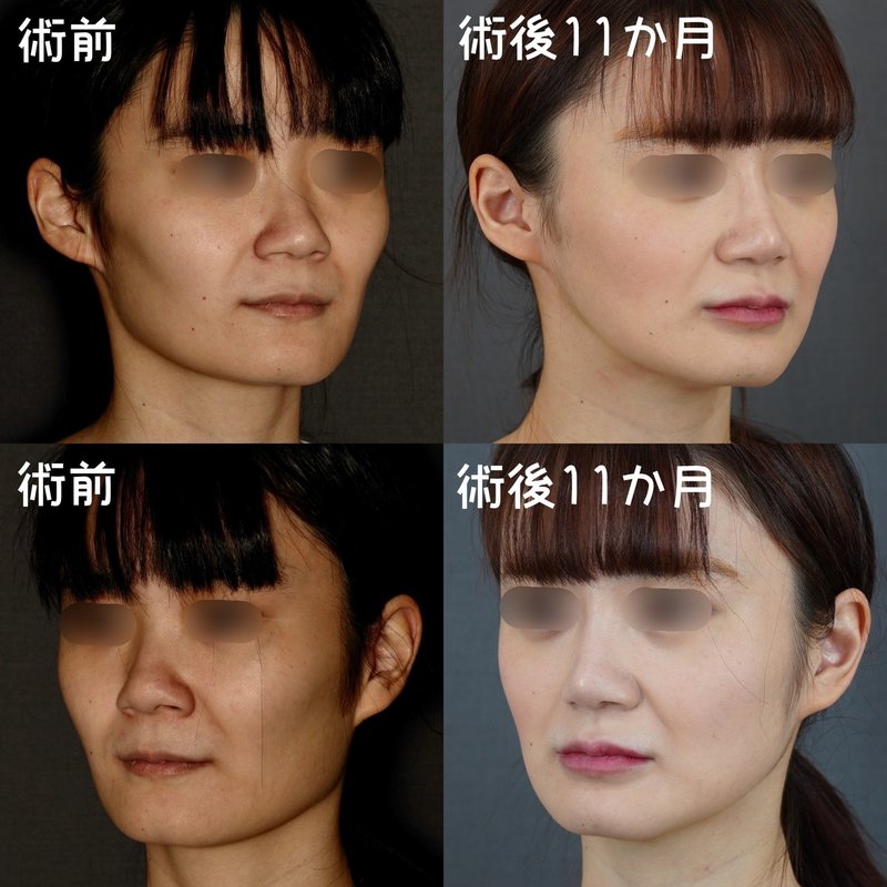 角張ったフェイスラインからの小顔の作り方 骨切りドクター宮崎 Note 角張ったフェイスラインからの小顔の作り方 骨切りドクター宮崎 Note