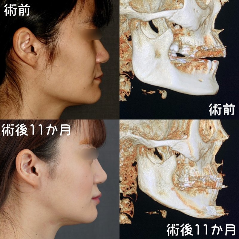 角張ったフェイスラインからの小顔の作り方 骨切りドクター宮崎 Note 角張ったフェイスラインからの小顔の作り方 骨切りドクター宮崎 Note