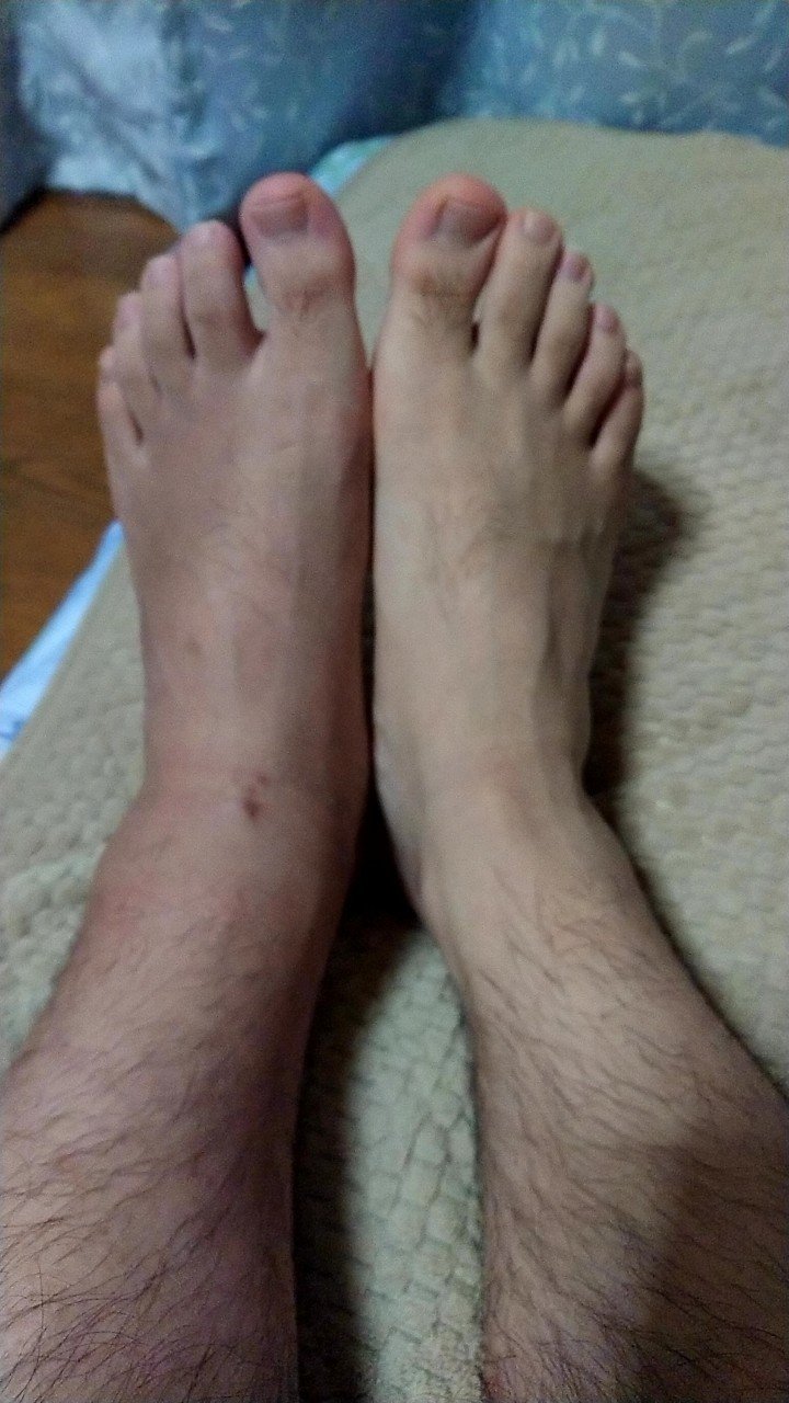 左足腓骨骨折 靭帯断裂闘病記 25 34日目 今が1番大事な時 なべマガジン Note 左足腓骨骨折 靭帯断裂闘病記 25 34日目 今が1番大事な時 なべマガジン Note