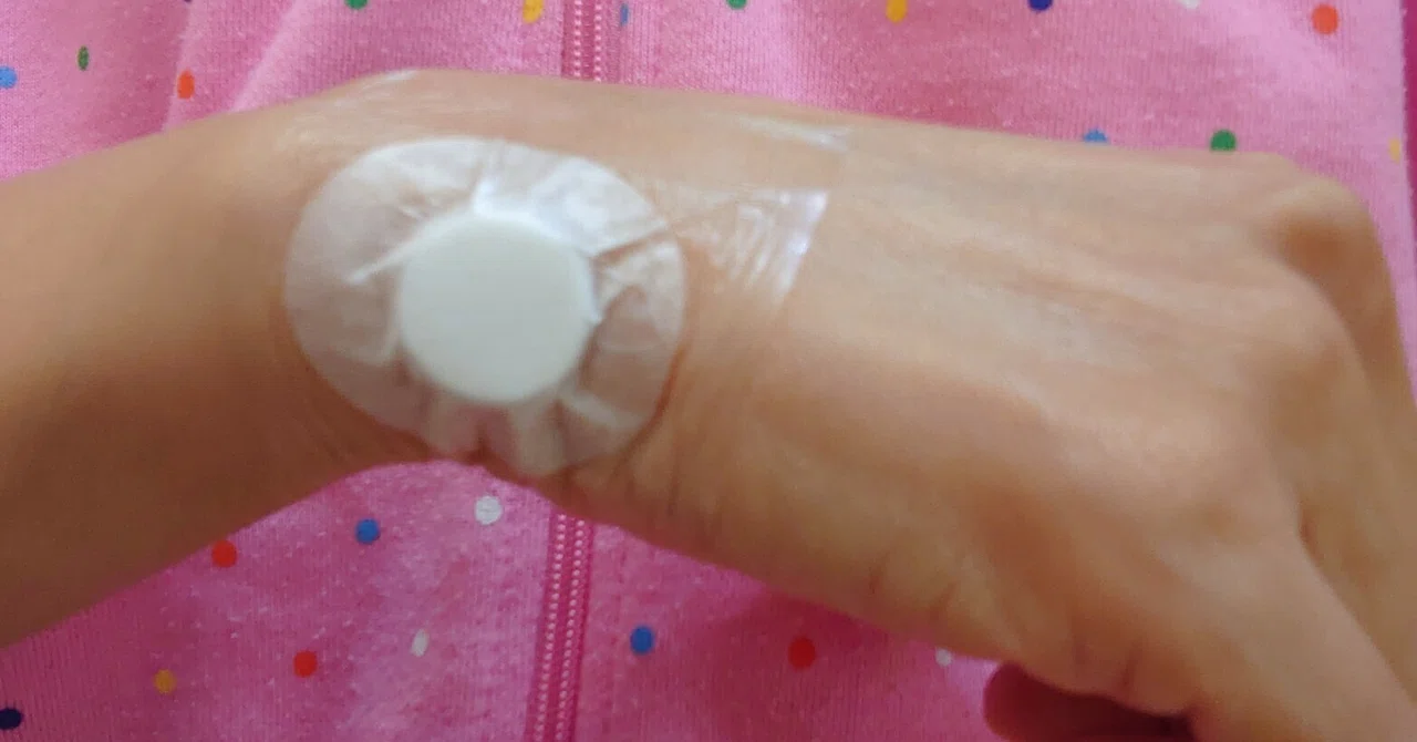 右手首の腱鞘炎🌟手術を決意 ‼️｜パプリカ
