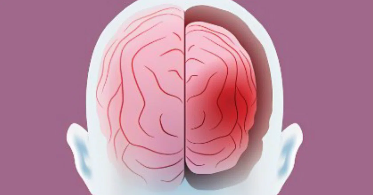 最新｜稀な脳細胞の損失が、ストレスがどのように認知症につながるかを説明する可能性がある、と研究が示している