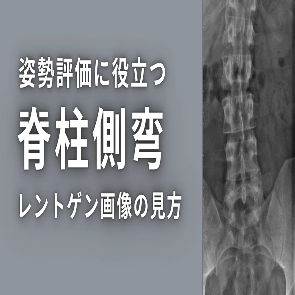 姿勢評価に役立つ脊柱側弯のレントゲン画像の見方｜理学療法士による