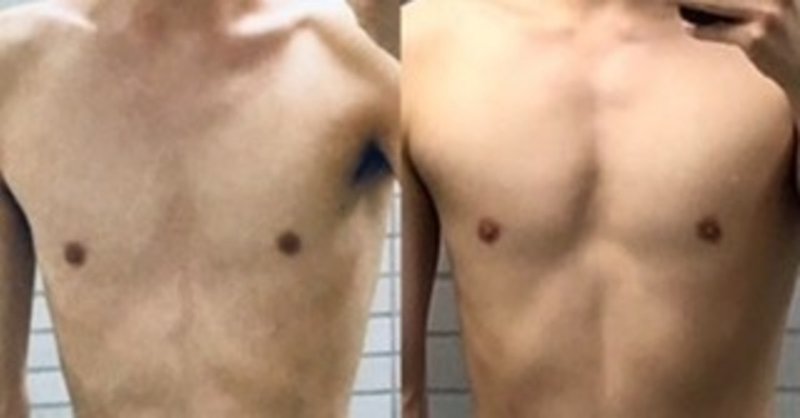 ナマケモノのガリガリ 漏斗胸が筋トレと食事で普通体型へ ナマケモノ Note