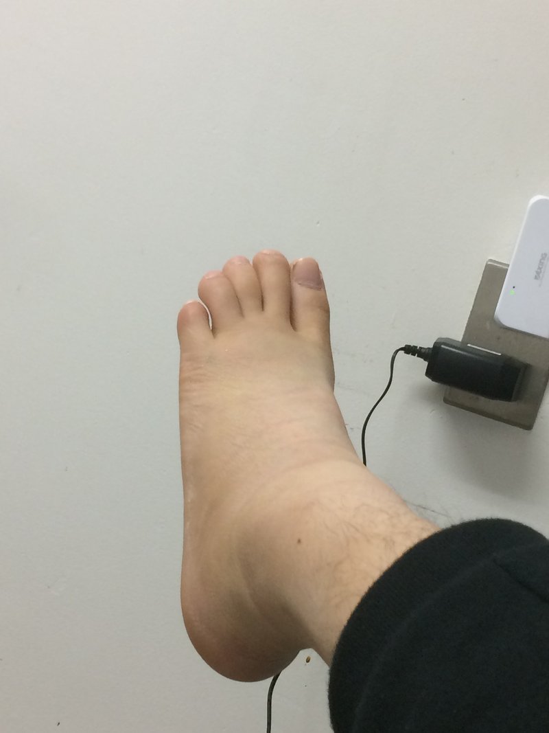 実体験 外果 くるぶし 骨折のリアル Ryota Shioura Note