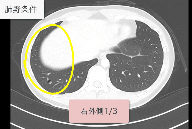胸部CTの読影の順番、見落としを防ぐためのコツ｜ごろ〜にゃ@放射線科