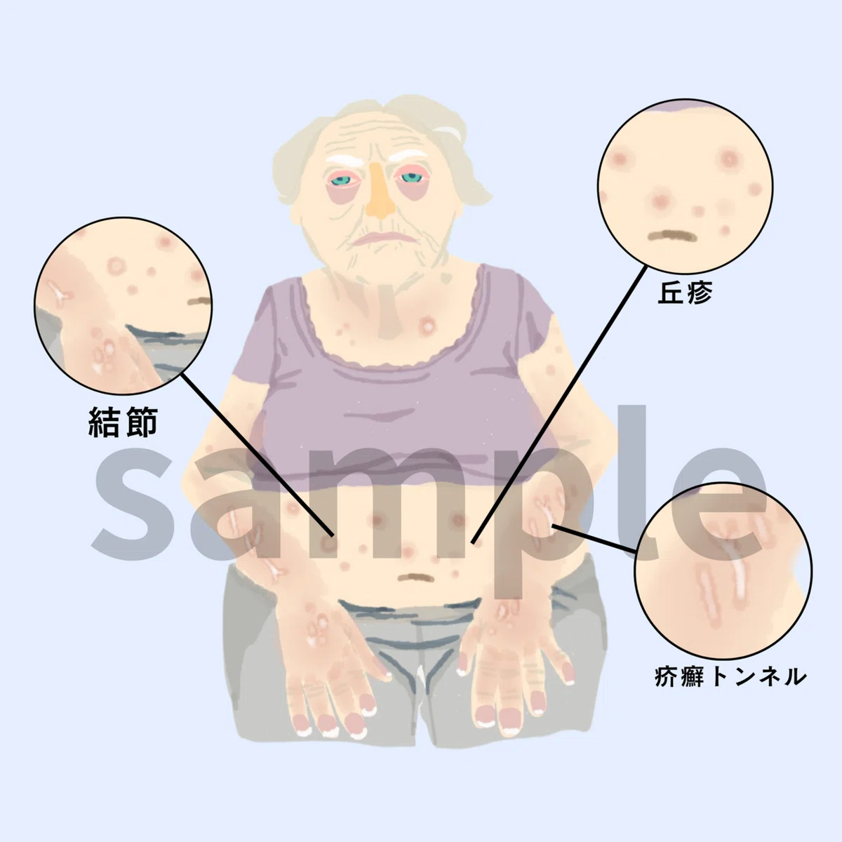 疥癬症状イラスト 看護学生・新人向け教材図版|症状の見分け方|ハックルベリージャム