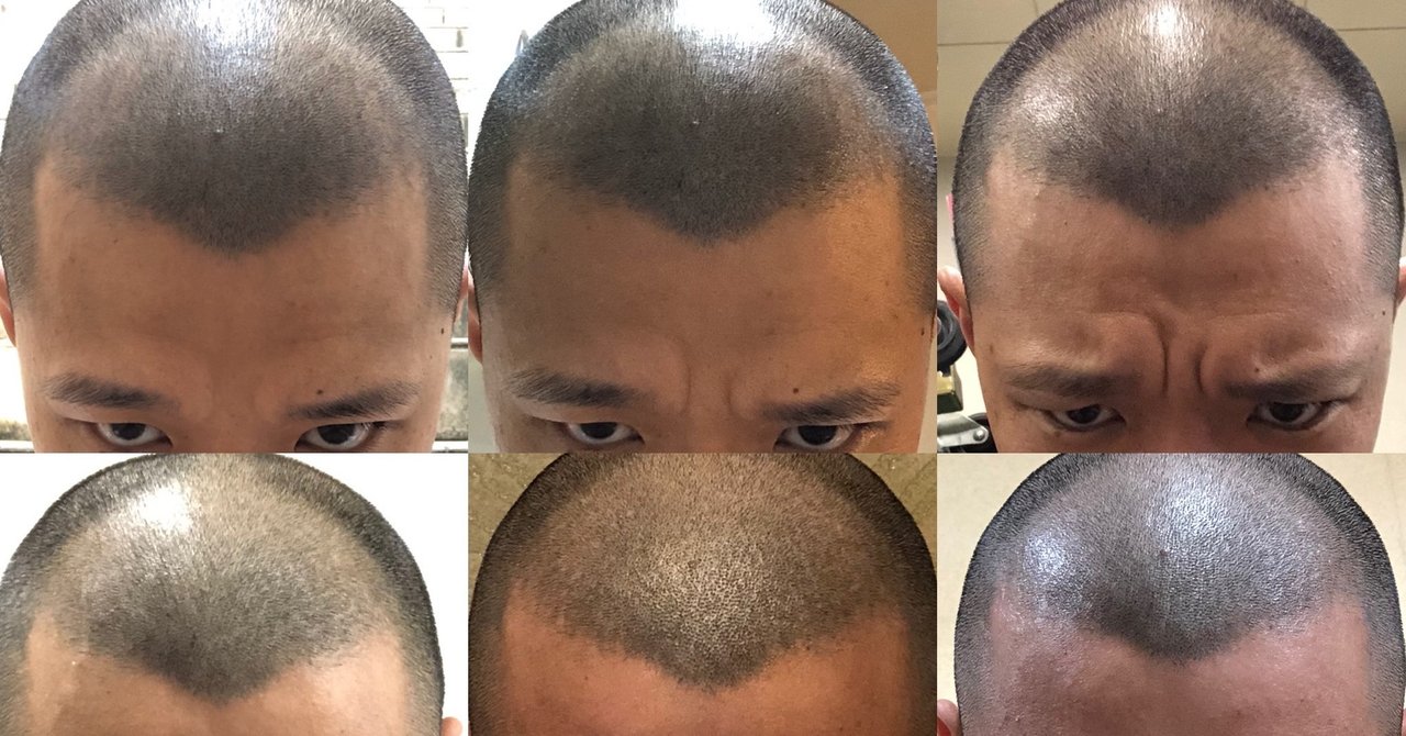 印刷可能 6 ミリ 坊主 画像