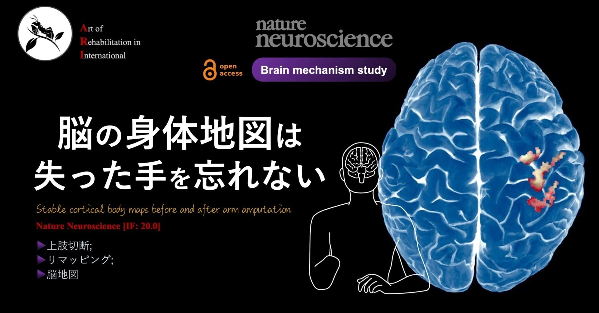 脳の身体地図は失った手を忘れない｜Super Human | 理学療法士／保健学