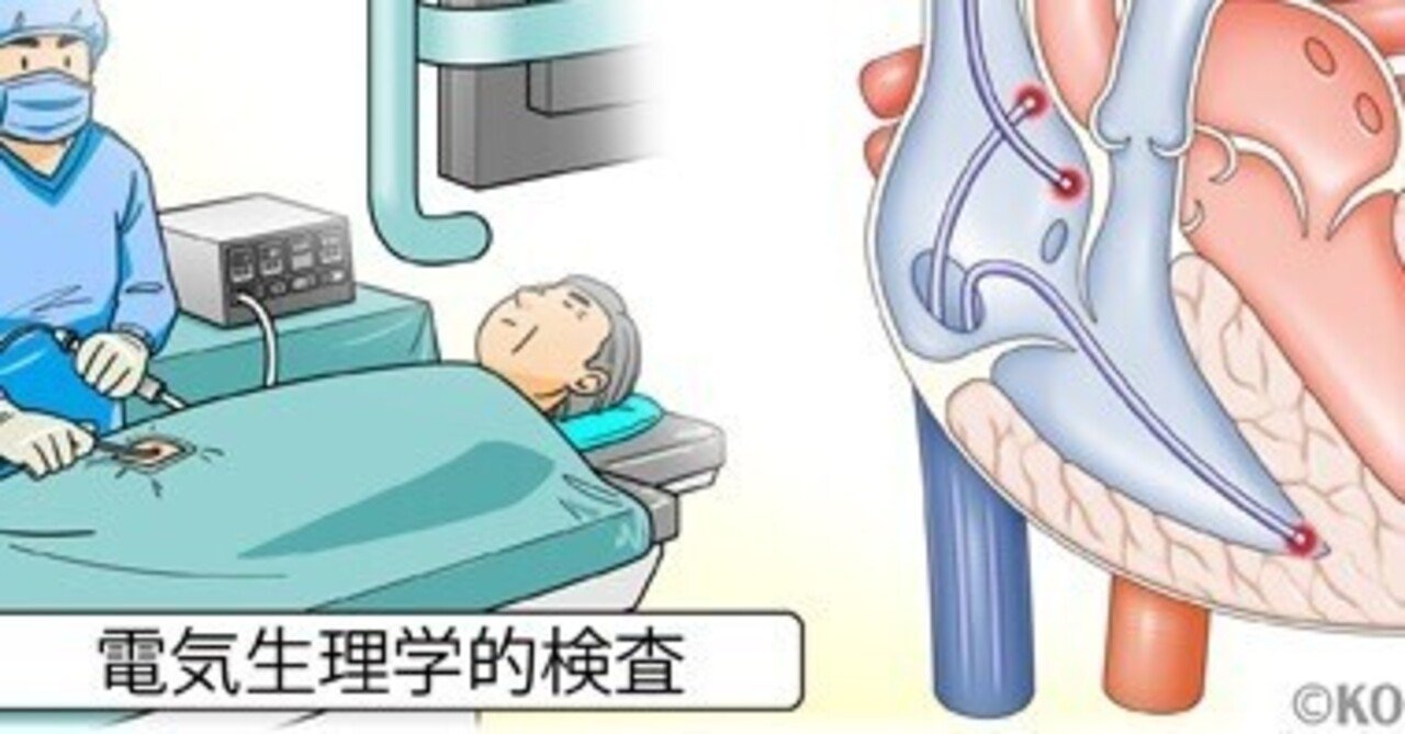 EPS(心臓電気生理学的検査)を受けてみて｜にゅ