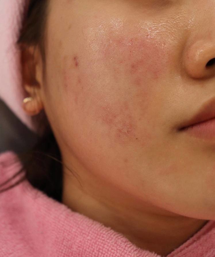 韓国の美容皮膚科 おすすめアンチエイジングの施術 クライオセル イルちゃん Note