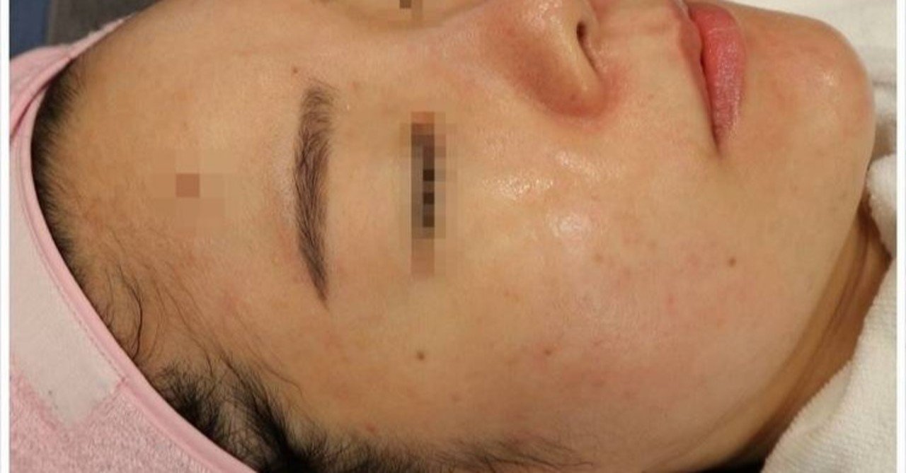 韓国の美容皮膚科 おすすめアンチエイジングの施術 クライオセル イルちゃん Note