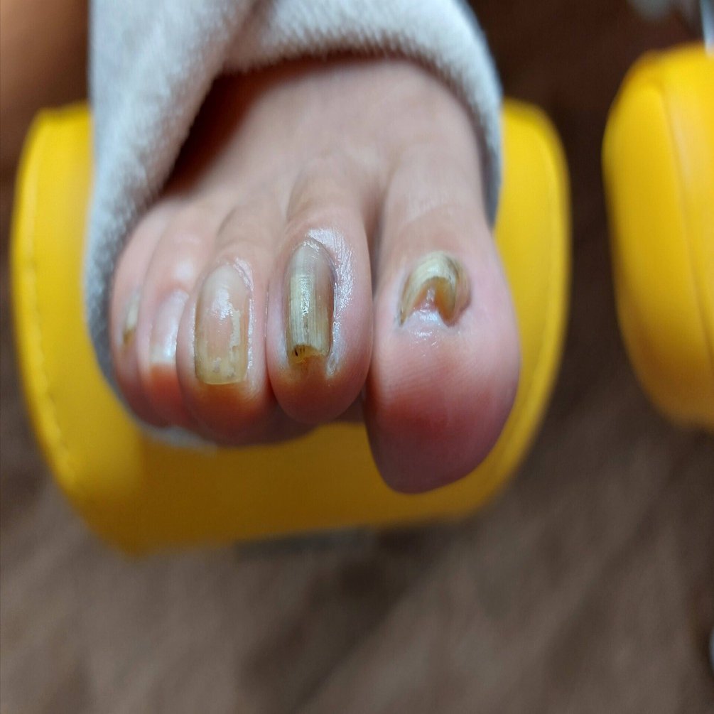 巻き爪リフト／PBスパンゲ】～技術研鑽とは～｜JPポドロジースクール