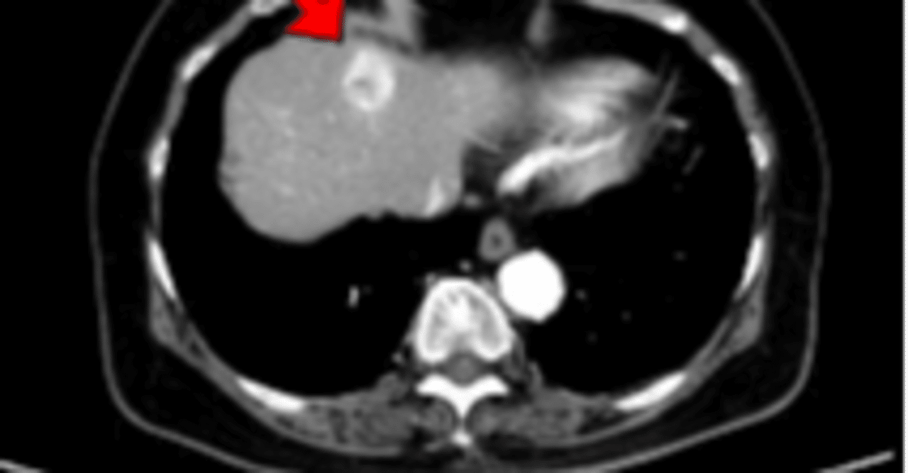 癌 ガン でなぜ人は死ぬのか 松中政樹 Note