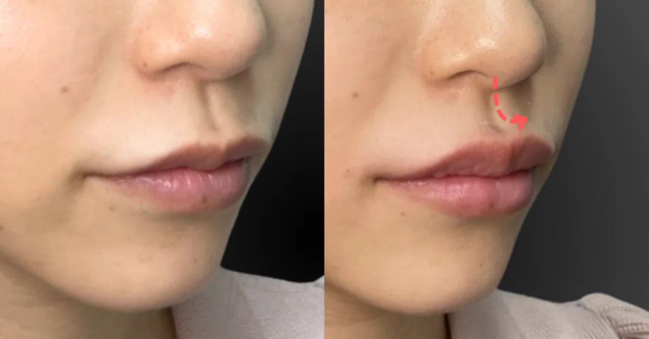 c type lip 20s Female] Achieving the Ideal C-Curl Lip ✨