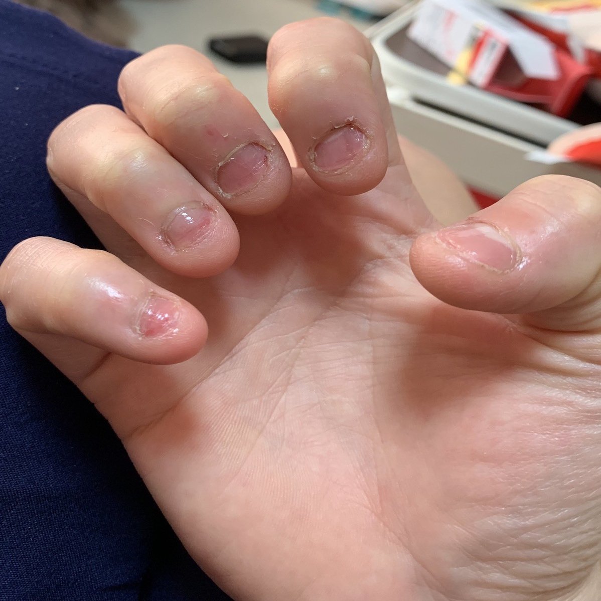 深爪のことはどうか けろた Note