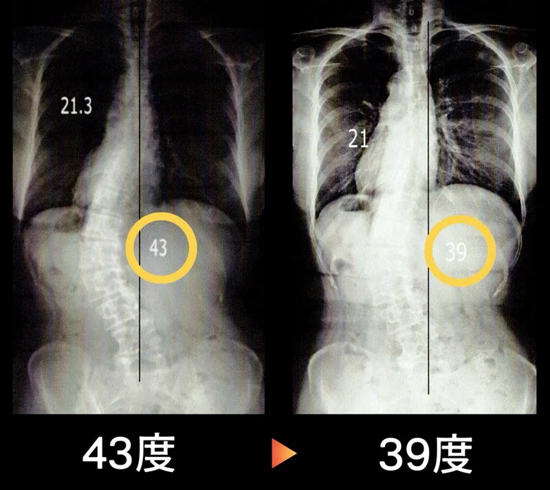 側弯症改善報告】43度➡︎39度へ改善！-60代女性-｜側弯症改善ヨガ