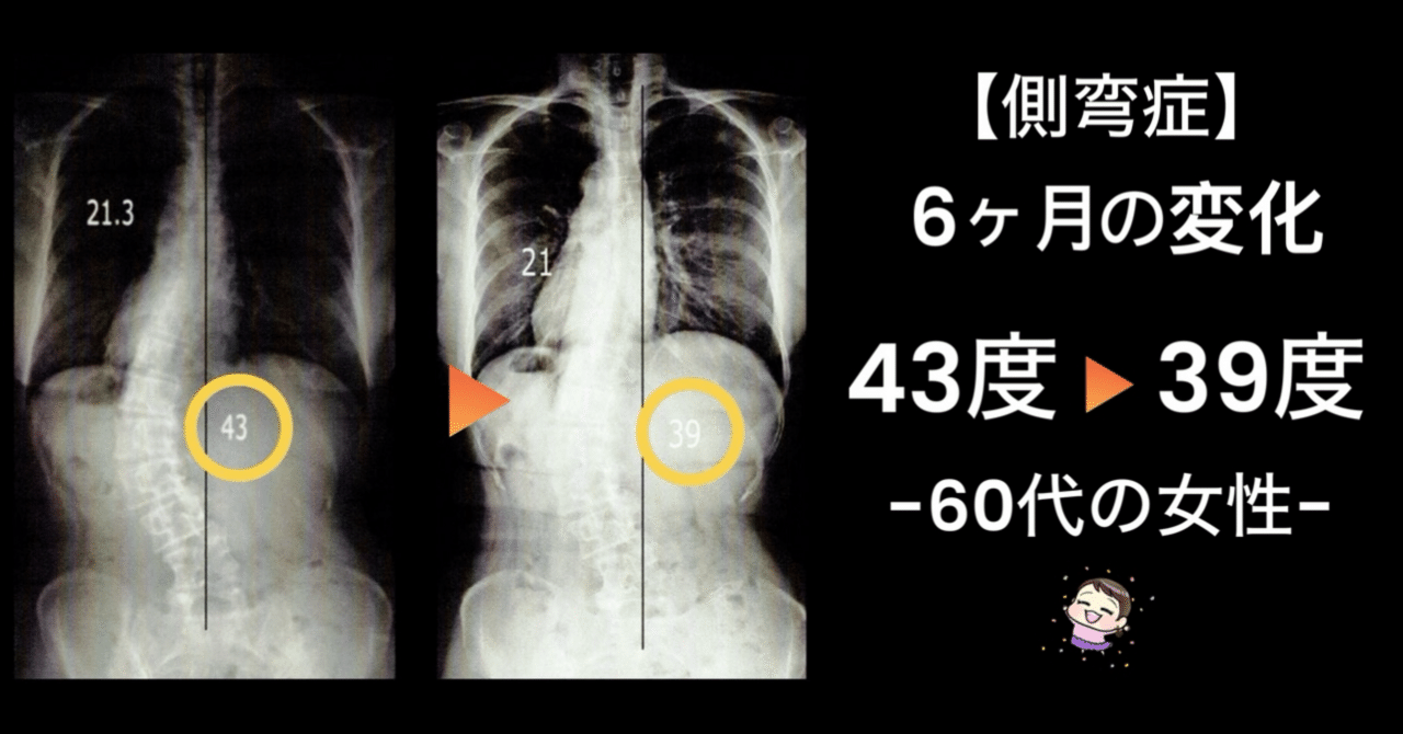 側弯症改善報告】43度➡︎39度へ改善！-60代女性-｜側弯症改善ヨガ
