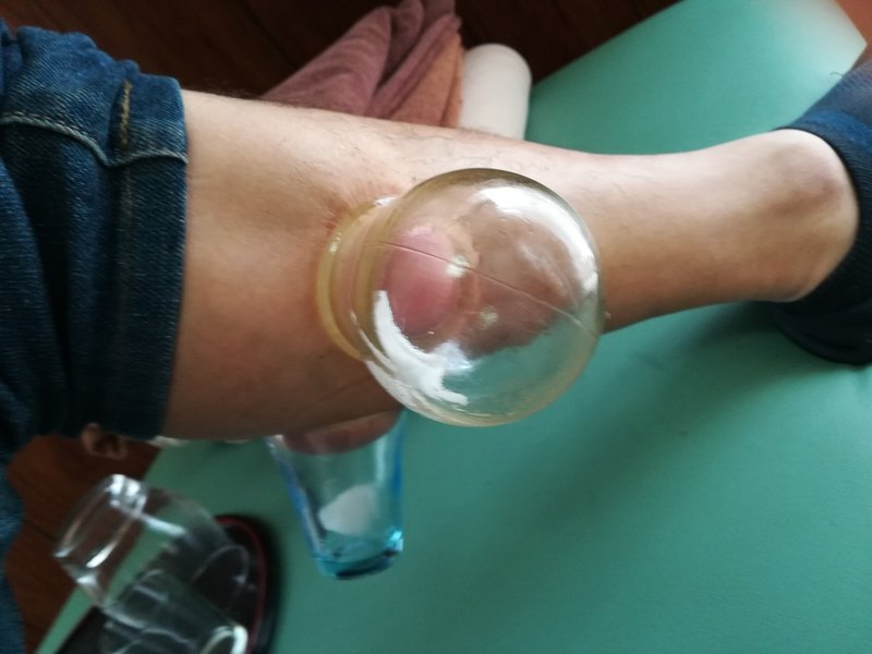 吸い玉 カッピングの効果と方法 アキレス腱の痛みが楽になる ゆら里 Note