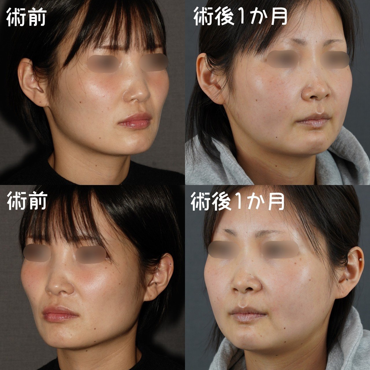 鼻整形】🇰🇷クリニック/料金/施術内容/カウンセリング資料/術前から日本で抜糸まで全て公開｜modern_loris8092, image size:1280x1280