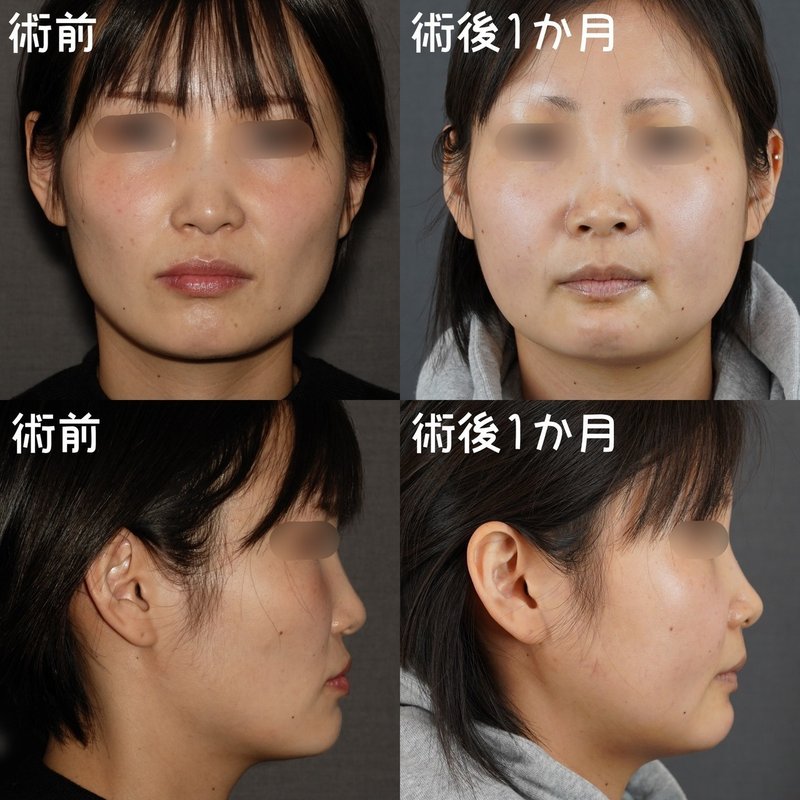 口元 Vラインを同時に整える 骨切りドクター宮崎 Note 口元 Vラインを同時に整える 骨切りドクター宮崎 Note
