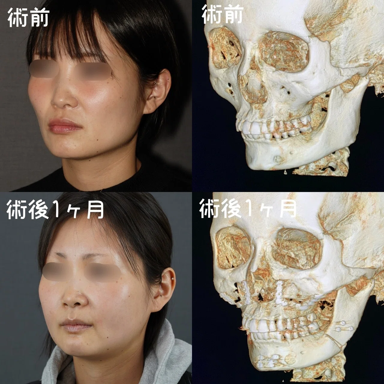 アゴになります 口元、Vラインを同時に整える｜Behind the Scalpel
