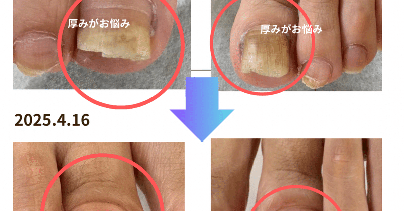 実録】足の爪の変化 - 2025-12｜阿邊里恵_rie abe｜note