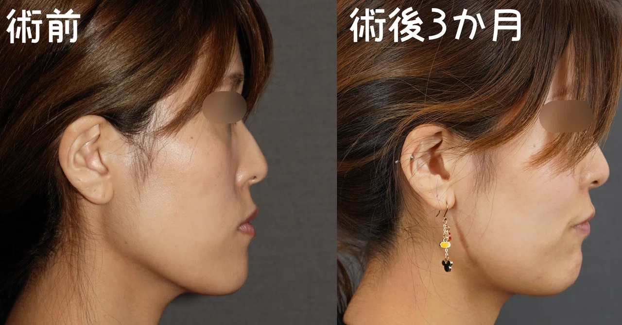 面長を変える 骨切りドクター宮崎 Note