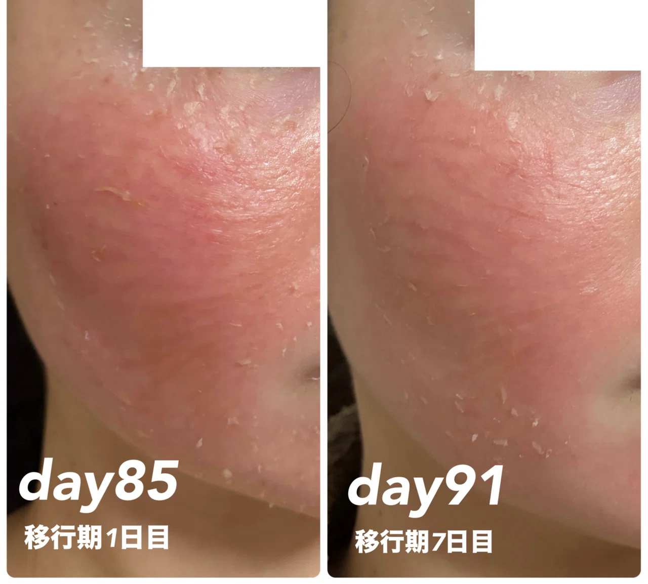 3ヶ月目】ゼオスキンで肌革命｜ぽめら