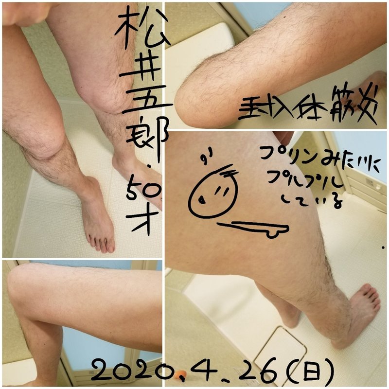 写真公開 封入体筋炎患者の大腿部の筋肉がこれだ 松井五郎 封入体筋炎 Note 写真公開 封入体筋炎患者の大腿部の筋肉がこれだ 松井五郎 封入体筋炎 Note