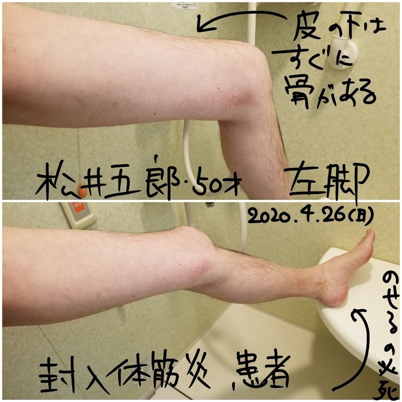 写真公開 封入体筋炎患者の大腿部の筋肉がこれだ 松井五郎 封入体筋炎 Note 写真公開 封入体筋炎患者の大腿部の筋肉がこれだ 松井五郎 封入体筋炎 Note