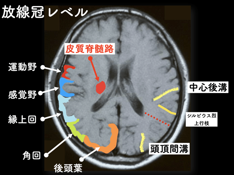 【サロン会員無料】 病巣と症状の関係は分かるが、そこからアプローチが分からなくなる。(15分）｜脳外臨床研究会&脳外