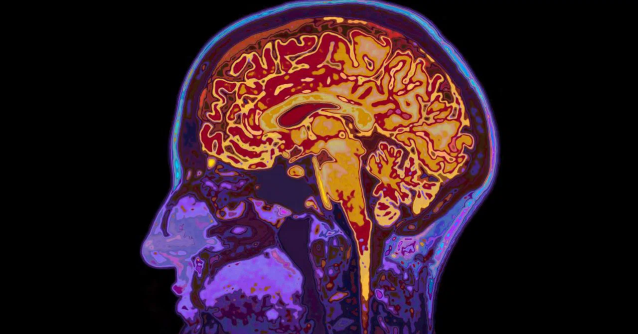 最新｜中年期の体重減少は脳の炎症を引き起こす可能性があると研究で判明