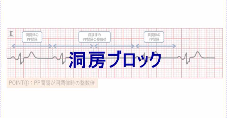 心電図イラスト 洞房ブロック Ceme Jpeg Note